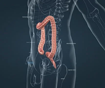 Appendicitis is a painful swelling of the appendix. Stock Illustration