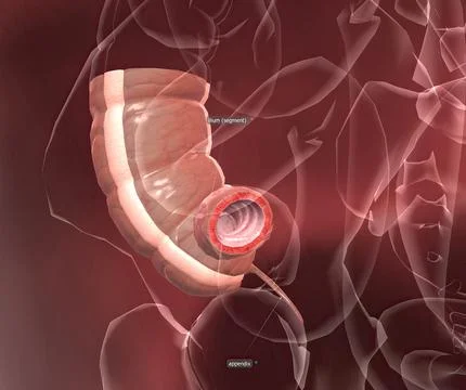 Appendicitis is a painful swelling of the appendix. Stock Illustration