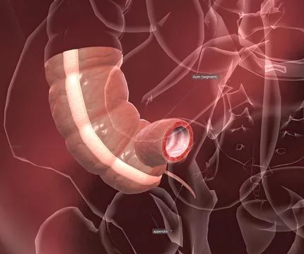 Appendicitis is a painful swelling of the appendix. 스톡 일러스트