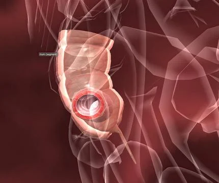 Appendicitis is a painful swelling of the appendix. Stock Illustration