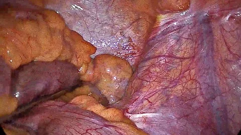 Appendicitis Surgery. View from the surgical camera of the process of Stock Footage 130113826