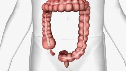 Appendicitis is when your appendix becomes sore, swollen, and diseased Stock Footage 244530225