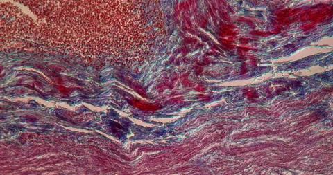 Appendix diseased tissue Stock Footage 145200590