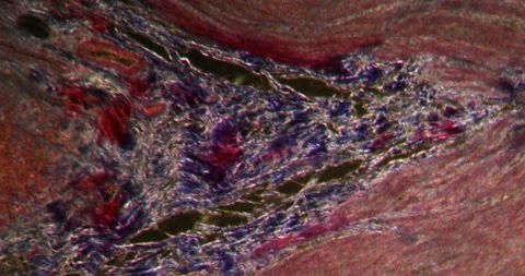 Appendix inflamation in Darkfield Stock Footage 147492004