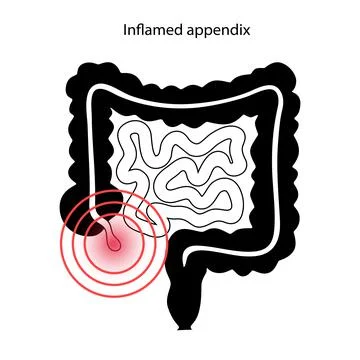 Appendix pain concept Stock Illustration