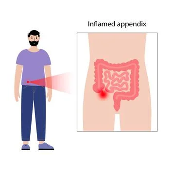 Appendix pain concept Stock Illustration