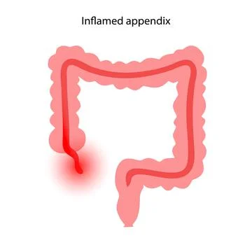 Appendix pain concept 스톡 일러스트