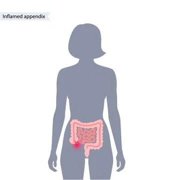 Appendix pain concept Stock Illustration