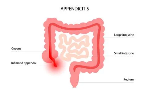 Appendix pain concept 스톡 일러스트