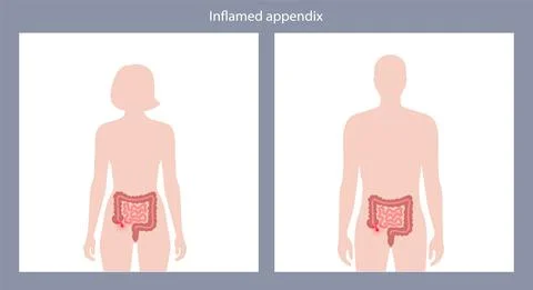 Appendix pain concept Stock Illustration