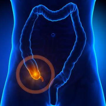 Appendix pain Stock-Illustration