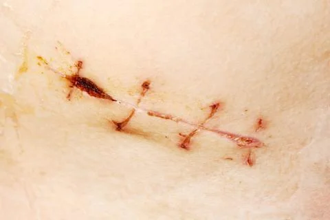 Appendix removal surgical suture Stock Photos