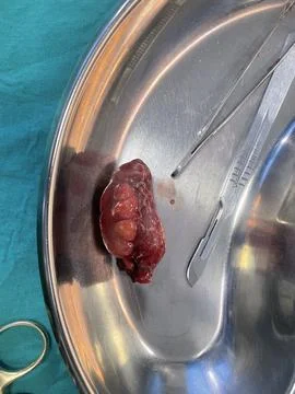 Appendix removed because of its inflammation Stock Photos