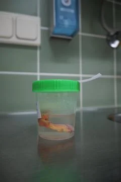 An appendix was placed in formalin in a preparation pot Foto stock