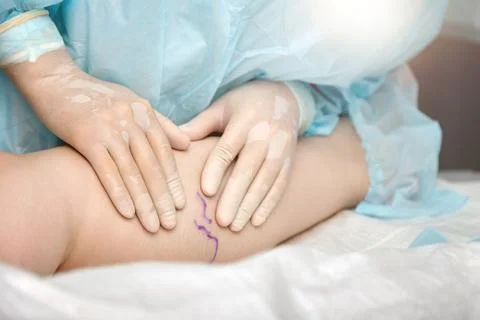 Application of schematic placement of a vein on the patient's leg before surgery Stock Photos