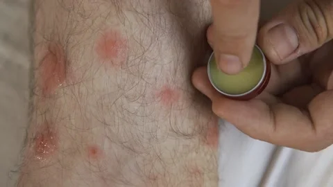 Application of therapeutic ointment for allergic rashes on the leg. Treatment of Stock Footage 157755220