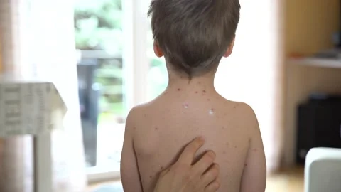 Apply anti-itch ointment to the back of a child with chickenpox Stock Footage 237932106