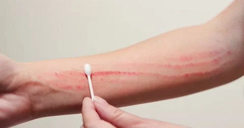 Apply ointment on forearm Stock-Footage 137003831