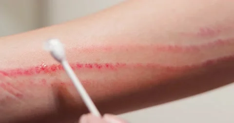 Apply ointment on forearm Stock Footage 137630797