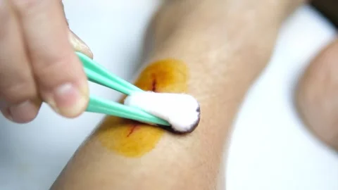 Applying Antiseptic Solution on Leg Wound First Aid and Infection Prevention Video stock 329354799