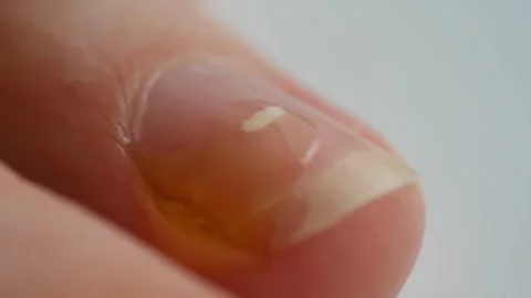 Applying cbd oil on fingernail affected by leukonychia in slow motion Stock Footage 312986788