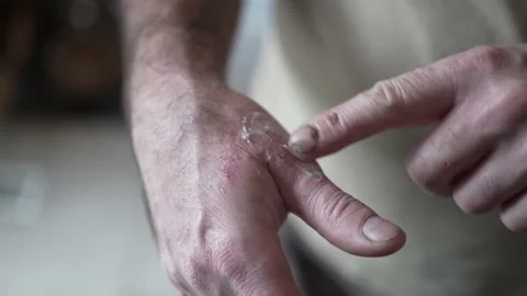Applying Cream on Hand With Eczema Closeup Stock Footage