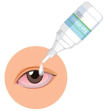 Applying Eye Drops to Red Irritated Eye Illustration Stock Illustration