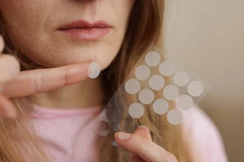 Applying Hydrocolloid Acne Patch On Face Skincare Treatment Closeup 스톡 사진