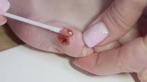 Applying medicinal ointment on a corn on the toe using a cotton swab. Stock Footage 302583294