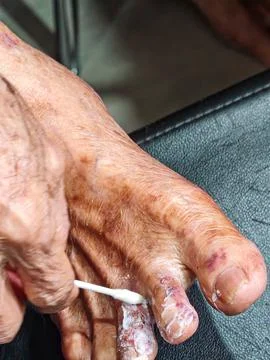 Applying medicinal ointment to an elderly person's foot with skin lesions an Stock Photos