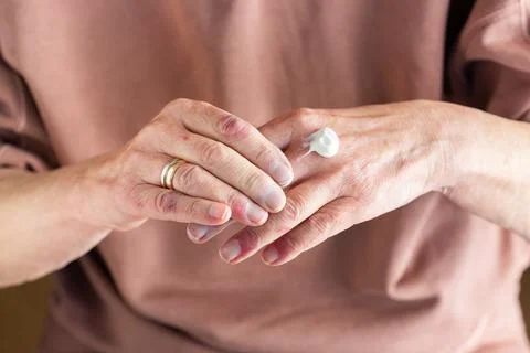 Applying ointment to hands with atopic dermatitis, eczema, allergy Stock Photos