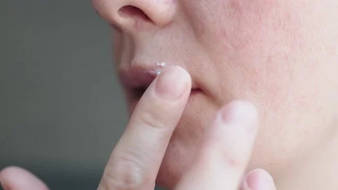 Applying ointment on herpes simplex pus-filled blisters bumps Video stock 235235635