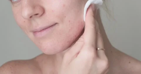 Applying toner on skin with acne. Stock Footage 160063823