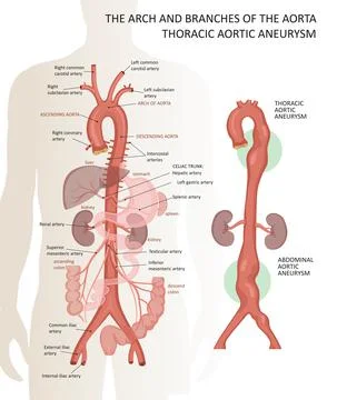 The arch and branches of the aorta. Thoracic aortic aneurysm Stock Illustration