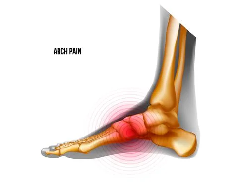 Arch of foot pain bones skeleton realistic anatomy illustration Stock Illustration