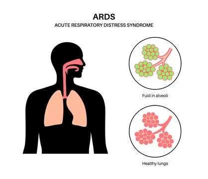 ARDS anatomical poster イラスト素材