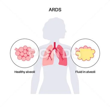 ARDS anatomical poster: Graphic #238480765