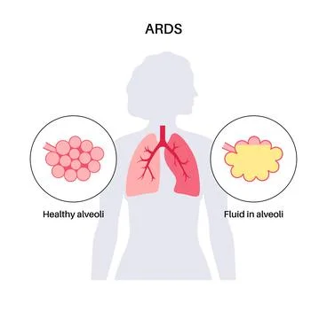 ARDS anatomical poster イラスト素材