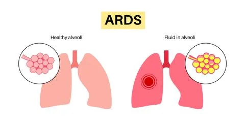 ARDS anatomical poster Stock Illustration