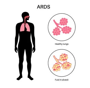 ARDS anatomical poster Ilustración de archivo