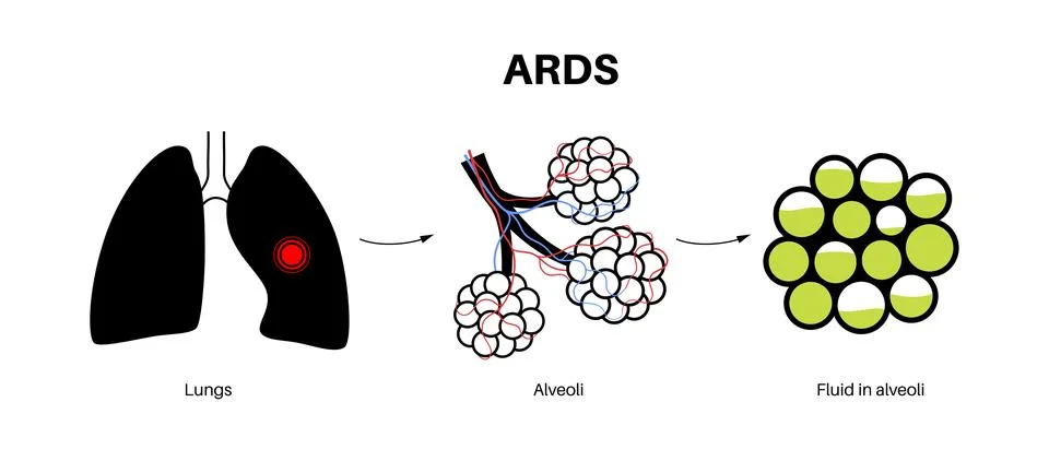 ARDS anatomical poster Ilustración de archivo