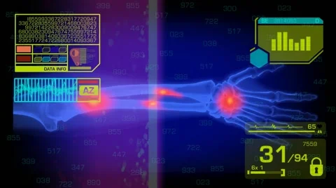 Arm Analysis - Graphics - Yellow 01 Stock Footage 56841761