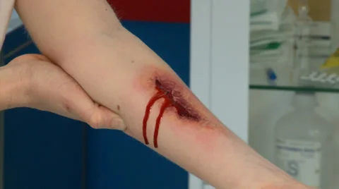ARM BLEEDING Stock Footage 35846605