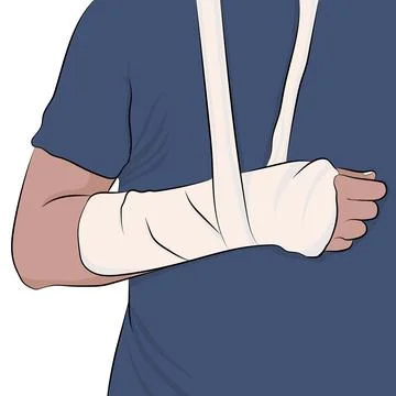 Arm in a cast 스톡 일러스트