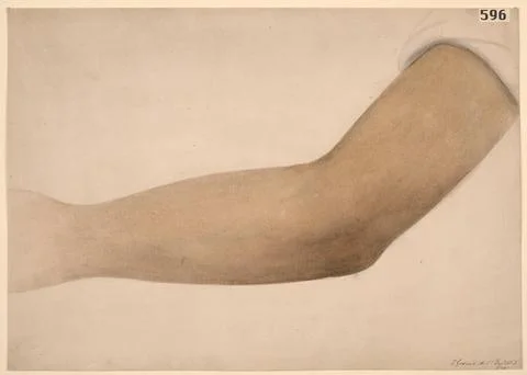 Arm with deep bronzing of the skin associated with Addision's disease Stock Illustration