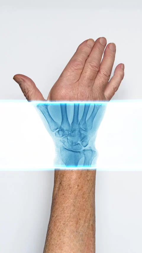 The arm of an elderly person under X-rays Stock Footage 304665720
