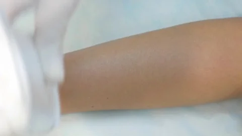 Arm Epilation Using Professional Equipment 스톡 동영상 73384820