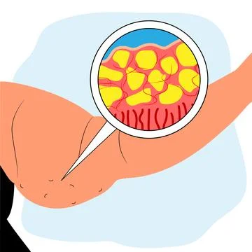 Arm Lipedema disease concept vector design Stock Illustration