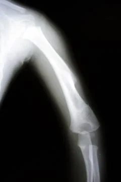 Arm tomography. Foto stock