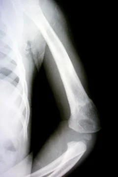 Arm tomography. Stock Photos